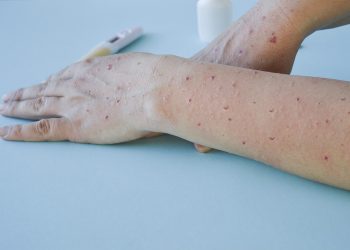 Cómo podemos prevenir las infecciones