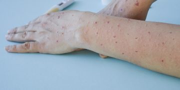 Cómo podemos prevenir las infecciones